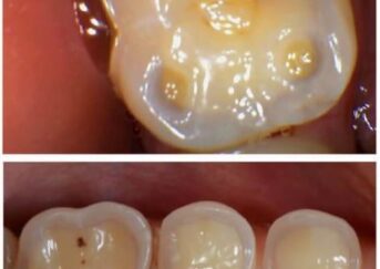 How To Avoid Acid Erosion