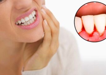 Bleeding Gums: What Does It Mean?