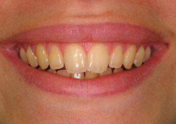Why Do Teeth Discolour?