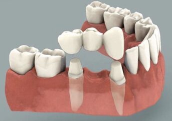 Types of Dental Bridges