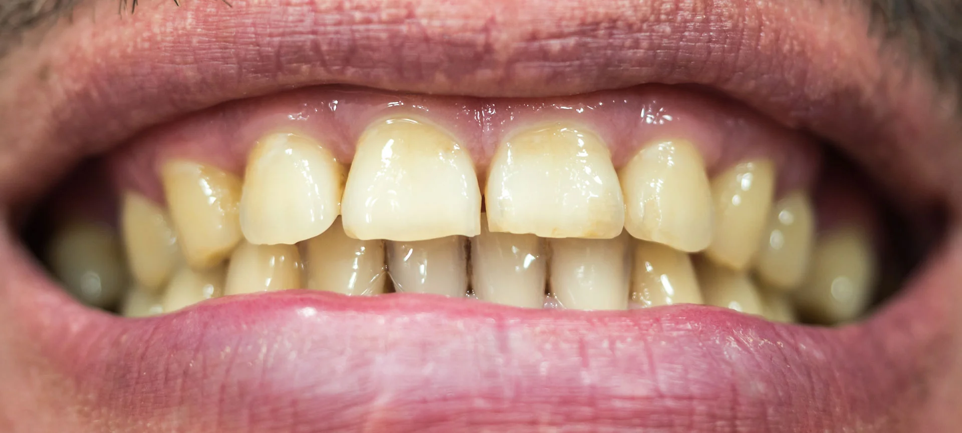 Discoloured Teeth