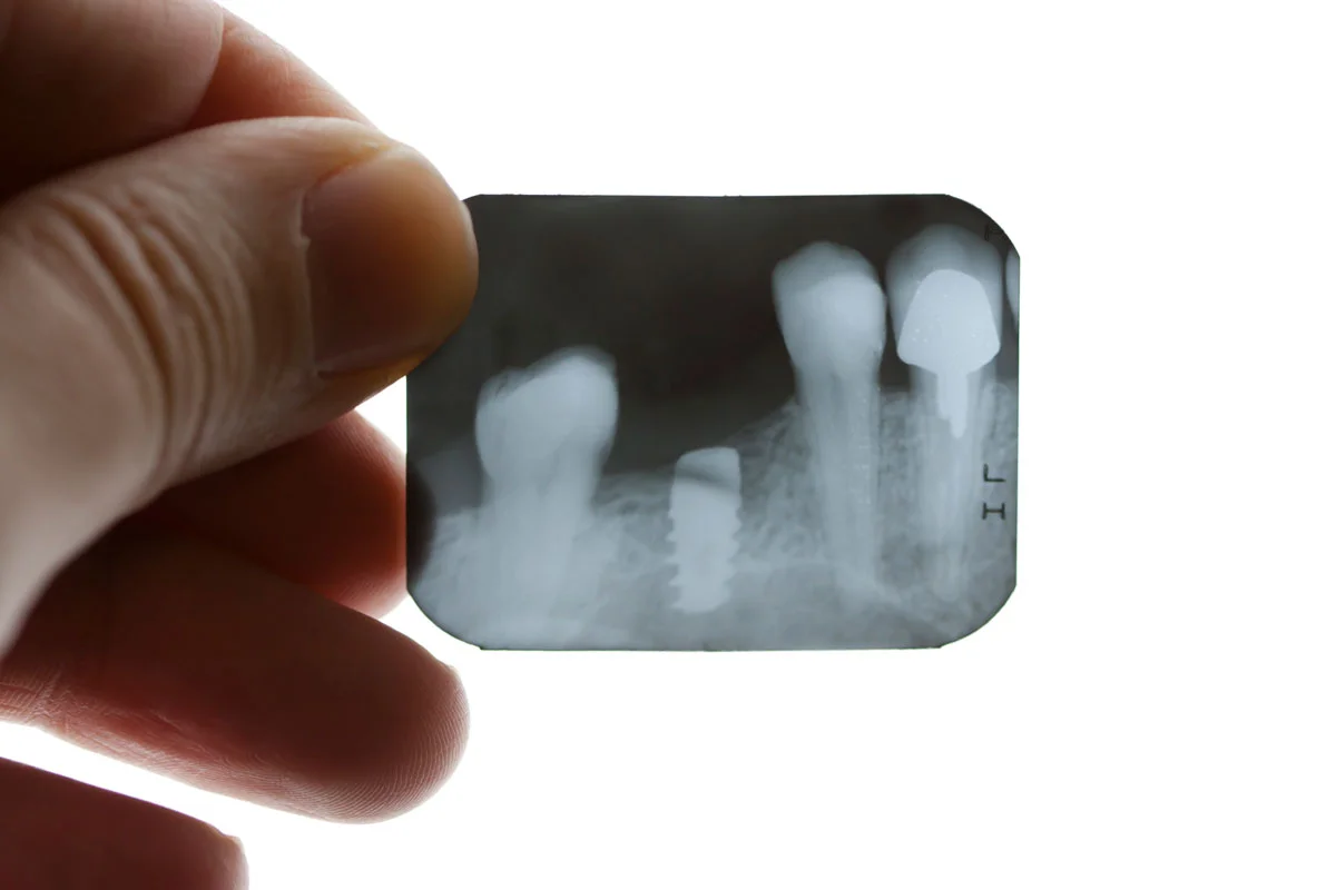 Implant Xray