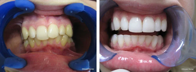 Tooth whitening before and after