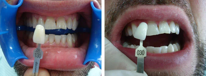 Tooth whitening before and after